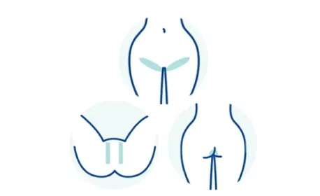 フェミークリニックの脱毛箇所イメージ画像