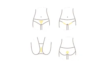 ウィルビークリニックの脱毛箇所イメージ画像